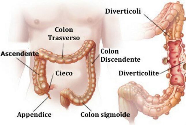 diverticulitis