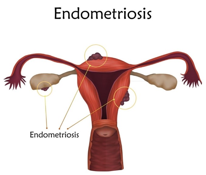 endometriosis síntomas, tratamiento
