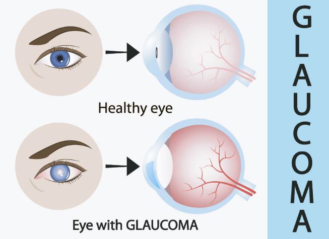 glaucoma vista
