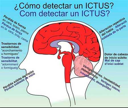Síntomas y Prevención del Ictus