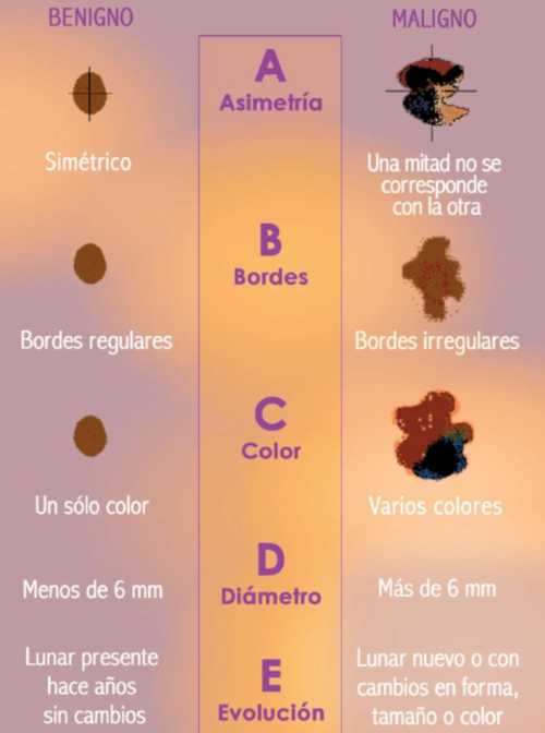 La regla del ABCDE para sospecha un melanoma