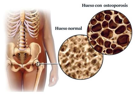 osteoporosis perdida osea