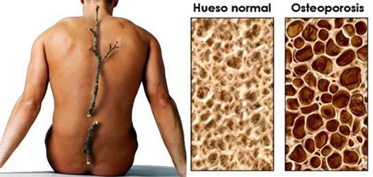 osteoporosis