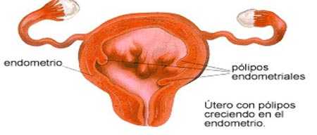 polipos endometriales