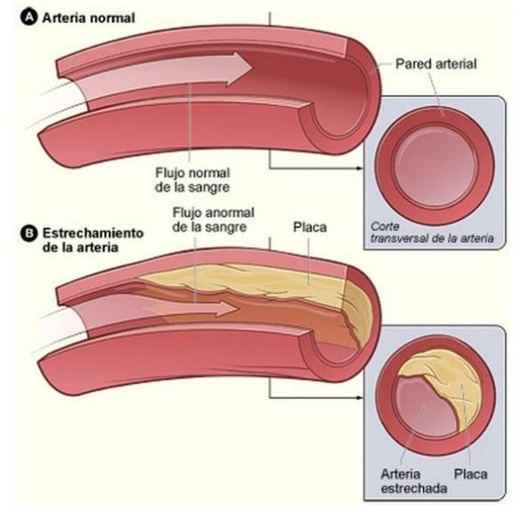 trombo arterial