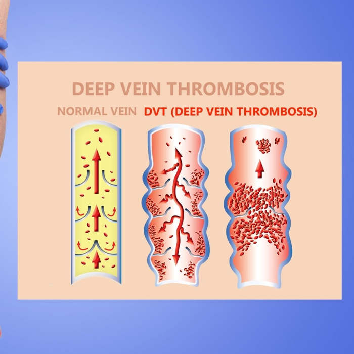 trombosis venosa embarazo, ¿Qué síntomas tiene una trombosis en la pierna?