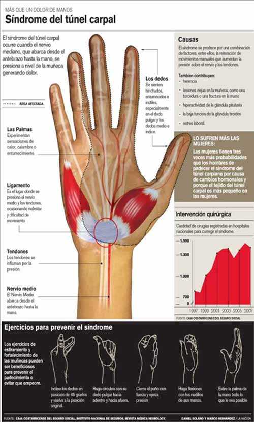 Síndrome de Túnel Carpiano