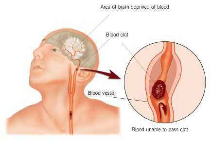 derrame cerebral