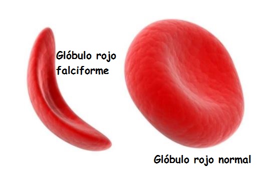 anemia falciforme