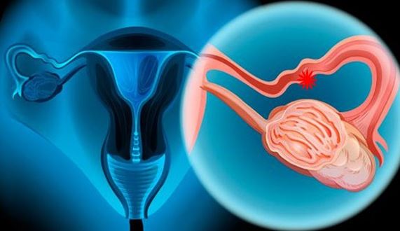 Cáncer de Ovario: síntomas, tipos, estadios y tratamiento