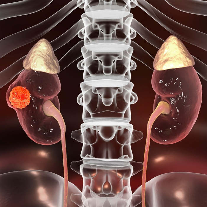 ¿Cuáles son los primeros síntomas de cáncer de riñón?