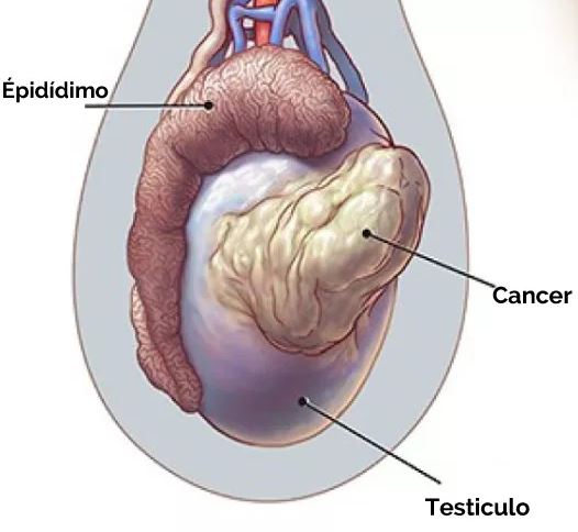 cancer testiculo