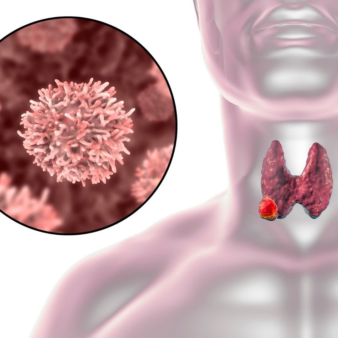 Cáncer de tiroides - Síntomas y causas