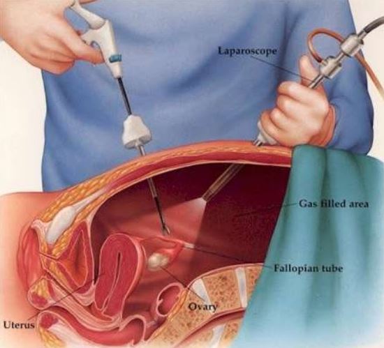 cáncer trompa falopio