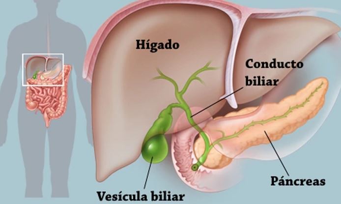 vesicula biliar, Colecistitis aguda