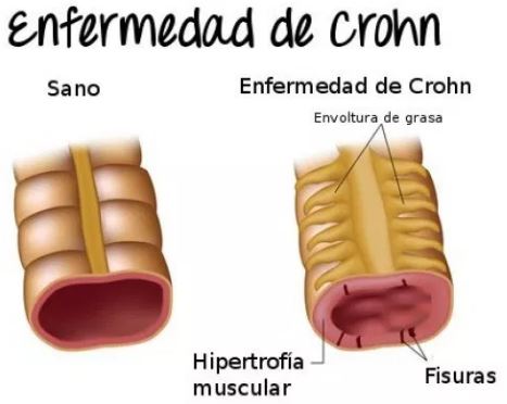 enfermedad inflamatoria intestinal