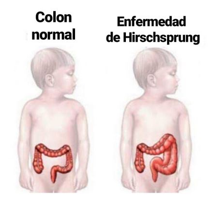 enfermedad hirschsprung