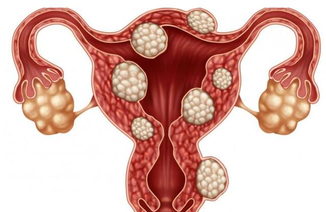 fibroide, fibromas, miomas