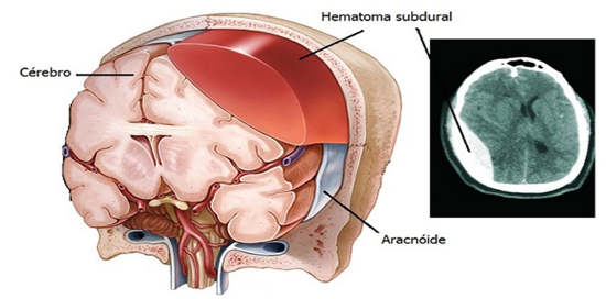 Hematoma subdural: causas, síntomas y tratamiento