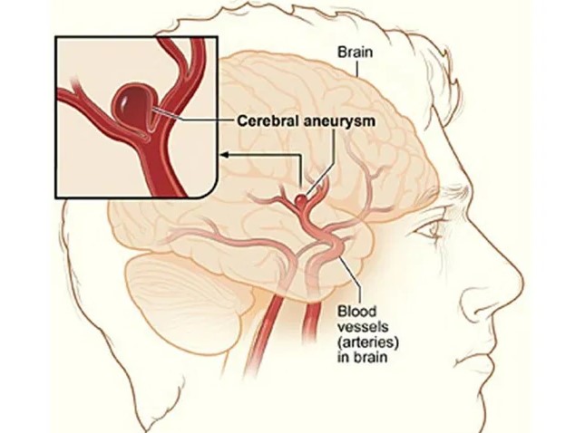 Hemorragia subaracnoidea - Enfermedades cerebrales