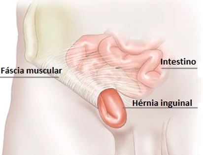 hernia inguinal