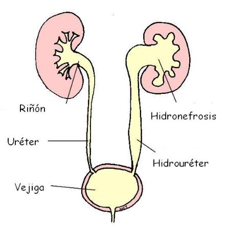 hidronefrosis