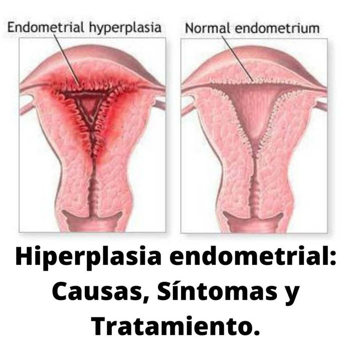 ¿Qué es la hiperplasia endometrial y por qué se produce?