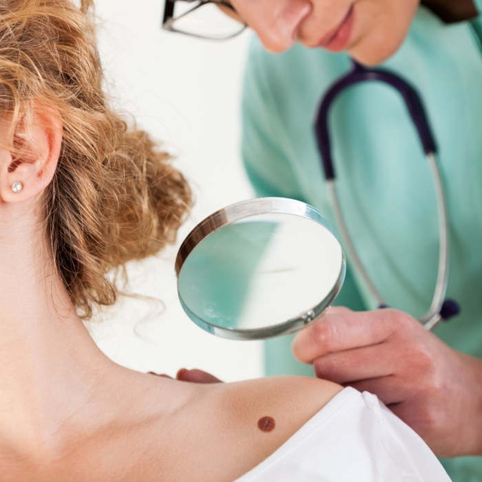 ¿Cómo comienza un melanoma?  ¿Qué tipos de melanomas hay?