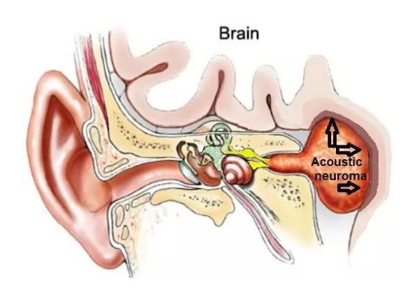neurinoma acustico