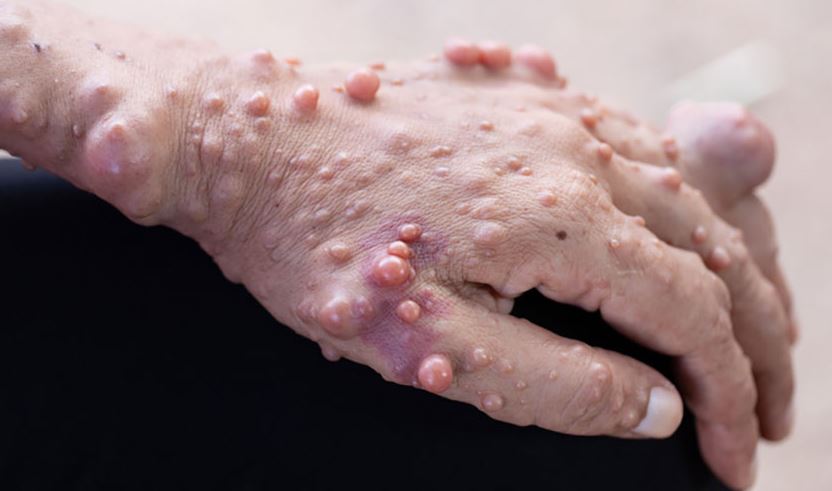 Neurofibromatosis