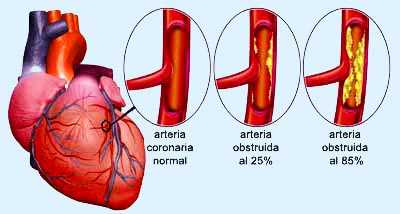 obstrucción arterial