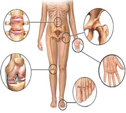 osteoartritis