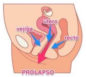 prolapso organos pelvicos