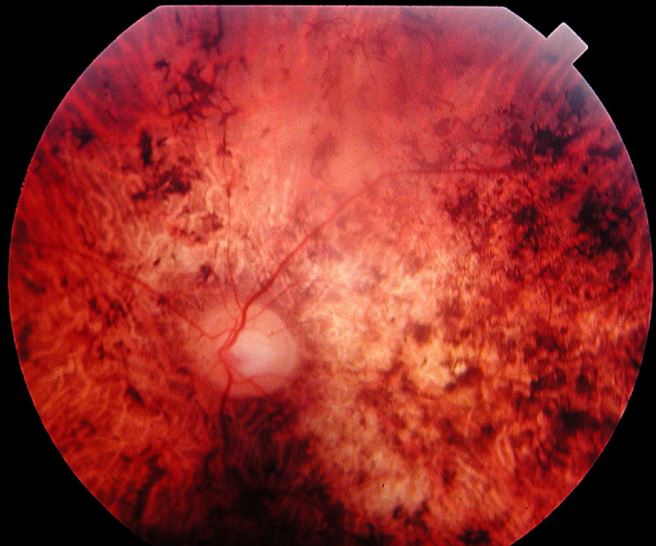 retinitis pigmentosa