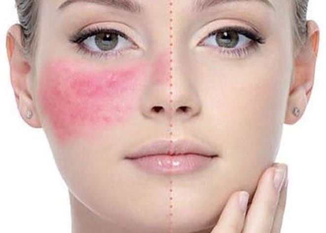 rosacea