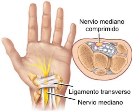 sindrome tunel carpiano