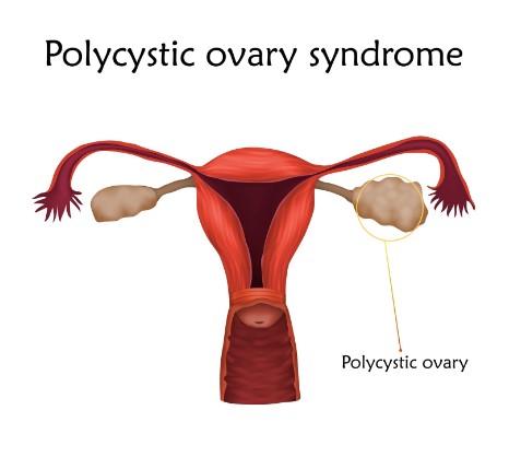 sop, ovarios poliquisticos