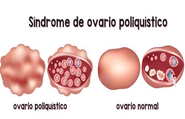 Ovarios poliquisticos y embarazo natural