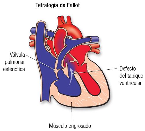 Tetralogía de fallot