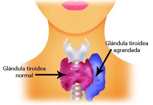 tiroides hiperactiva