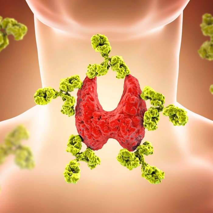 Tiroiditis crónica, Enfermedad de Hashimoto