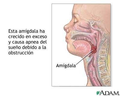 apnea-obstructiva