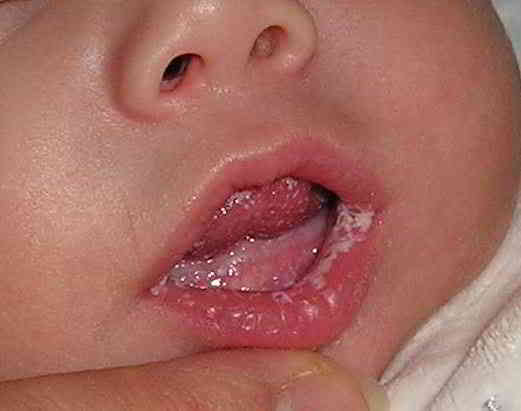 candidiasis oral, lengua blanca bebé, hongos boca y lengua