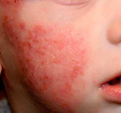 dermatitis atopica