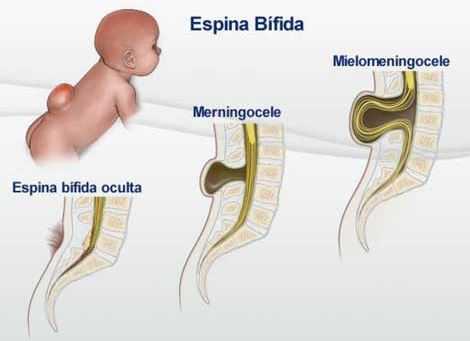 espina bifida tipos