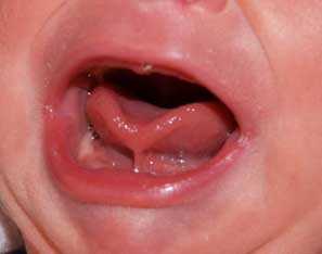 frenillo corto en bebés, frenillo sublingual, anquiloglosia