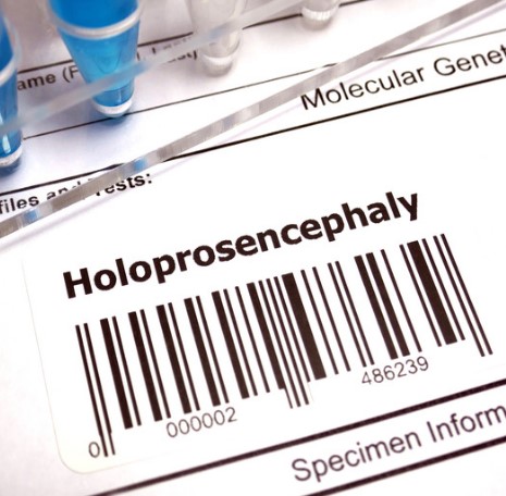¿Qué es la holoprosencefalia?  ¿Cuál es la causa de la holoprosencefalia?