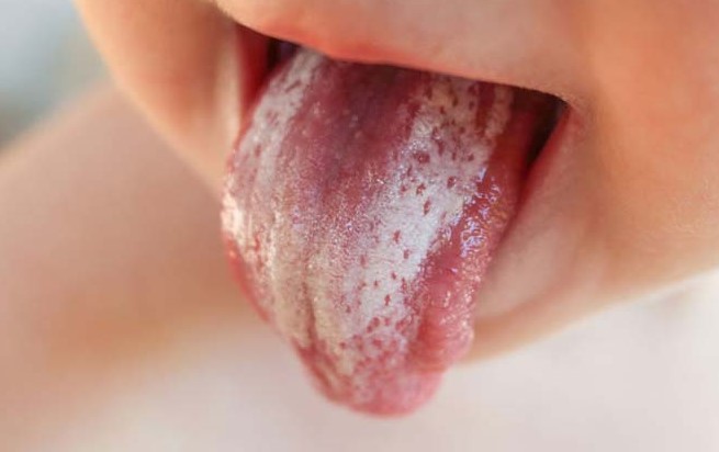 candidiasis oral, lengua blanca bebé, hongos boca y lengua